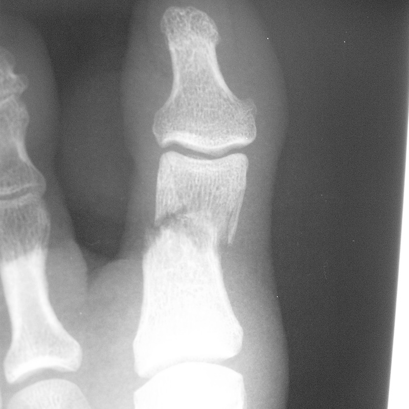 Foot Condition - Bone Fracture