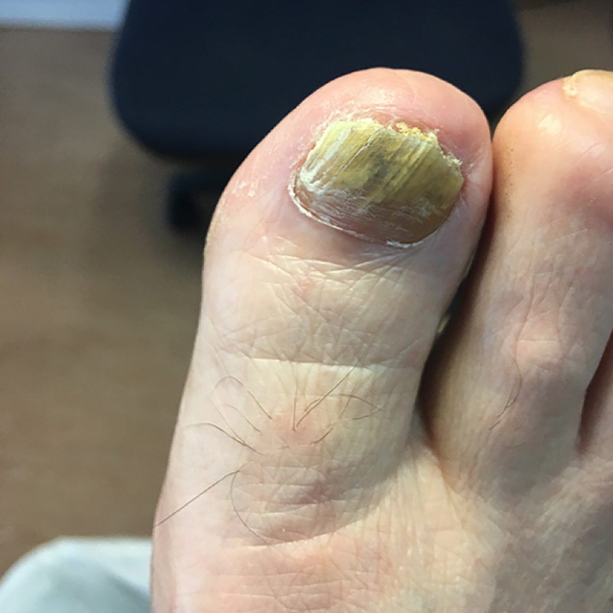 Fungal Nail Infection Causes, Symptoms and Treatment