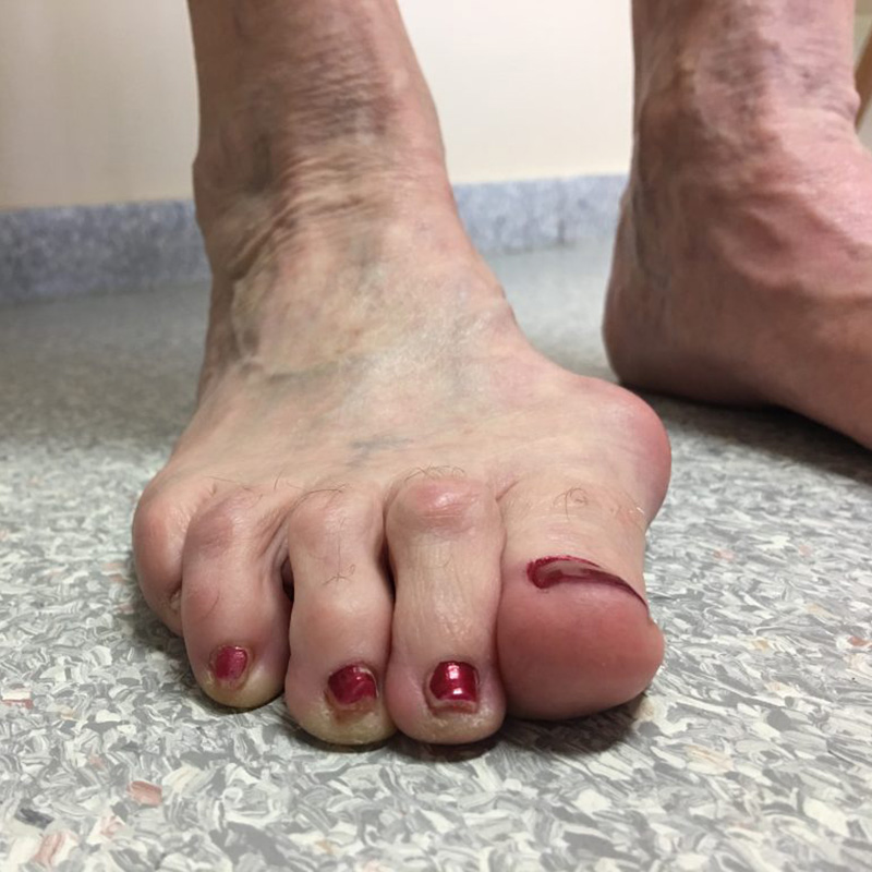 Foot Condition - Hammer Toe