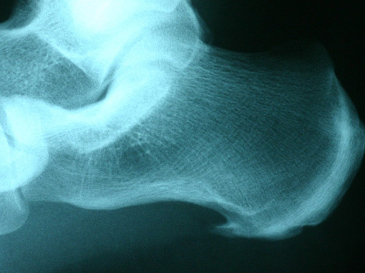 Plantar calcaneal spur | Radiology Reference Article | Radiopaedia.org