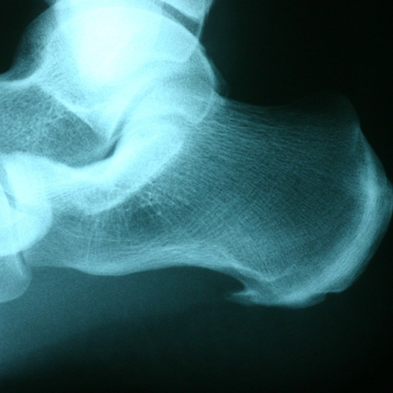 Foot Condition - Heel-spur-and-plantar-fascitis