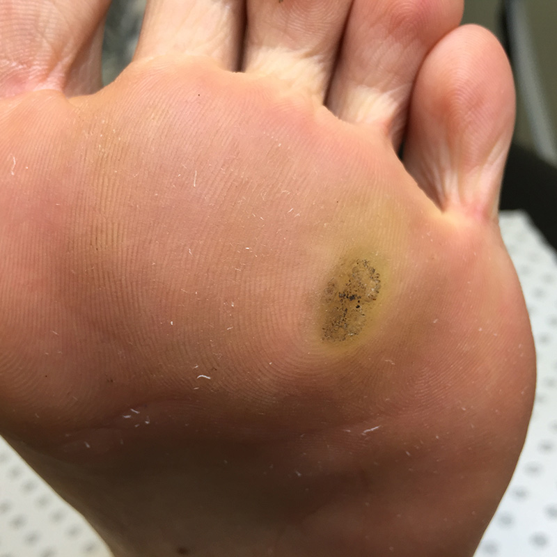 Foot Condition - Wart
