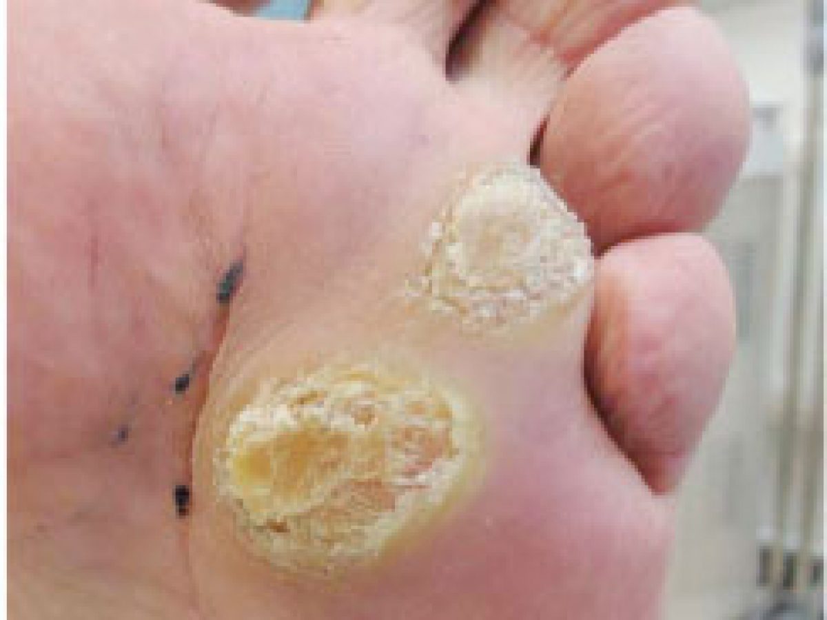 Papillomavirus in feet