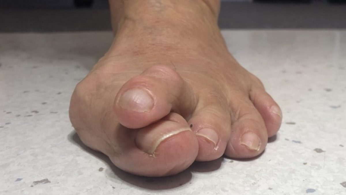 Hammer Toes: Causes, Diagnosis, Treatment - Foot And Ankle