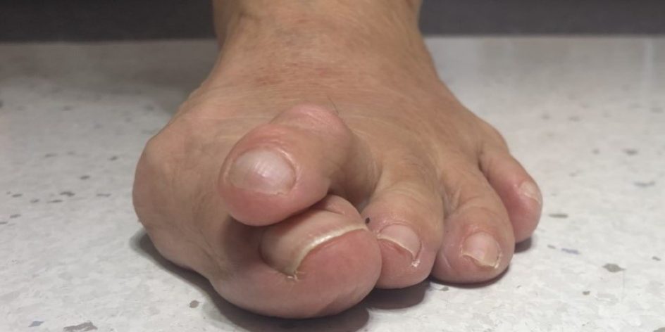 Hammertoe Surgery - Arches Foot Institute Surprise AZ Podiatrist
