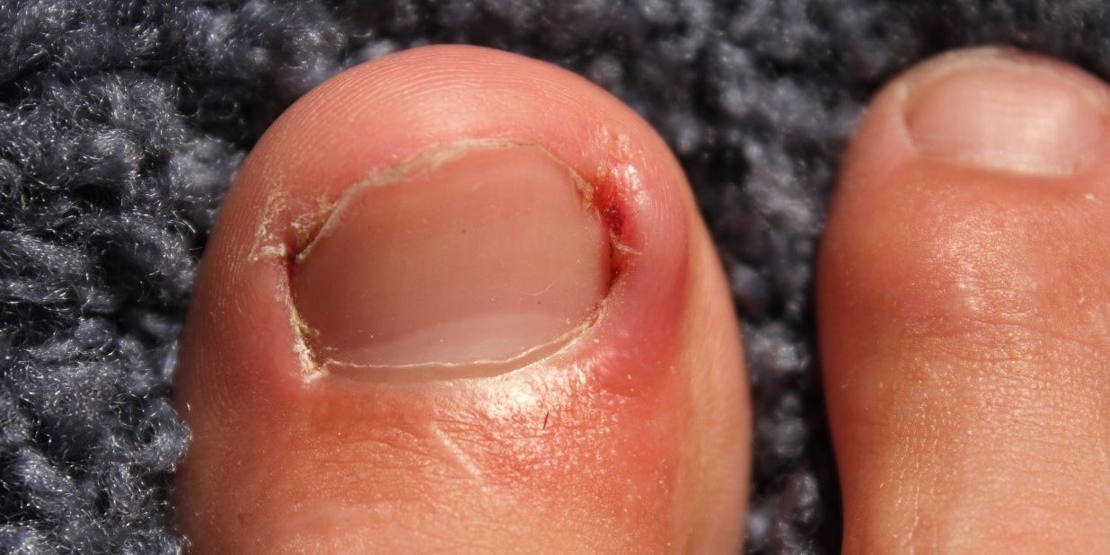 How to Prevent and Treat Ingrown Toenails - Foot And Ankle
