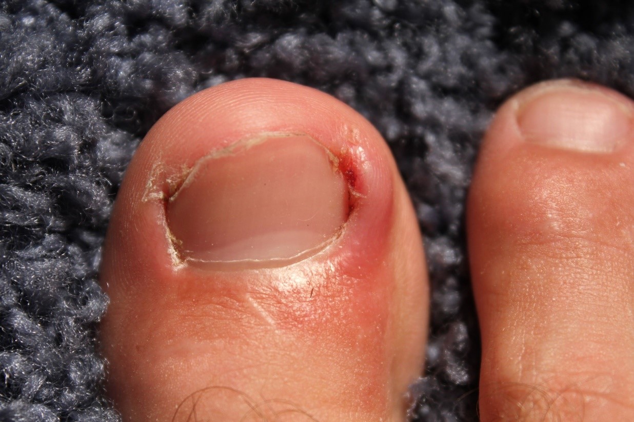 How to Prevent and Treat Ingrown Toenails - Foot And Ankle