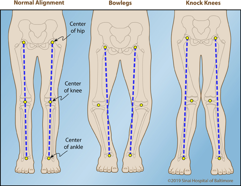 bow legs common foot problem in children