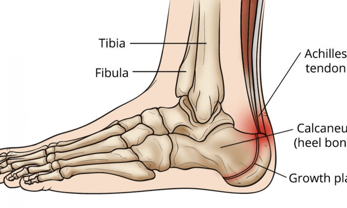 Bottom Of Heel Hurts [Causes, Home Remedies & Best Treatment]