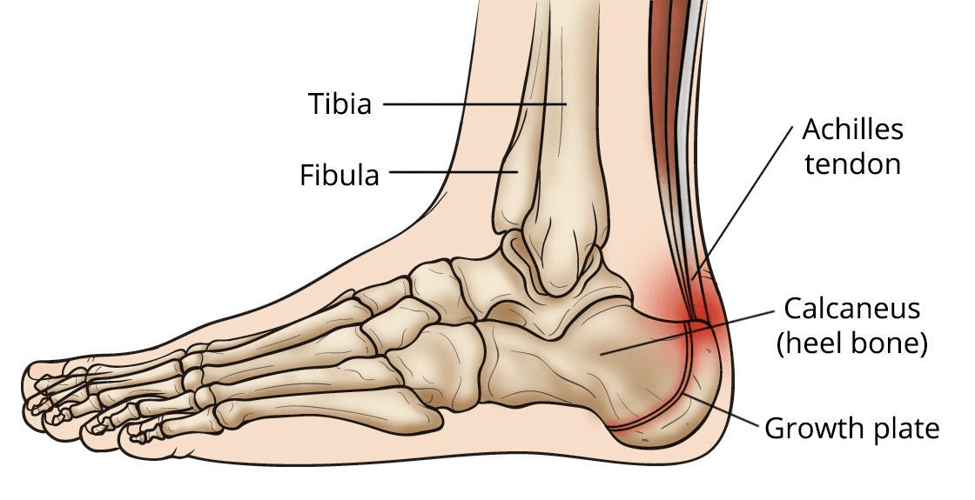 heel pain common foot problems in children