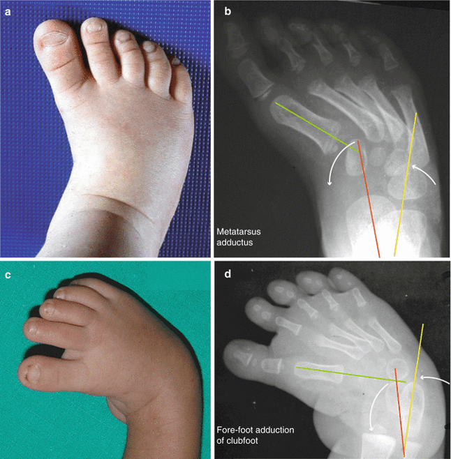 in-toeing common foot problem in children