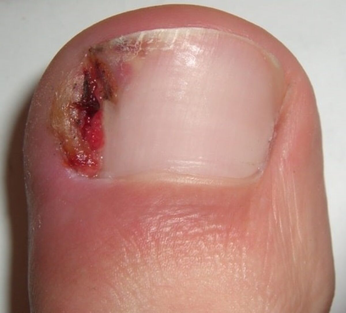 Ingrown Toenails  Northern Rivers Podiatry