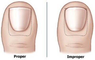 proper toenail cutting to avoid ingrown toenails
