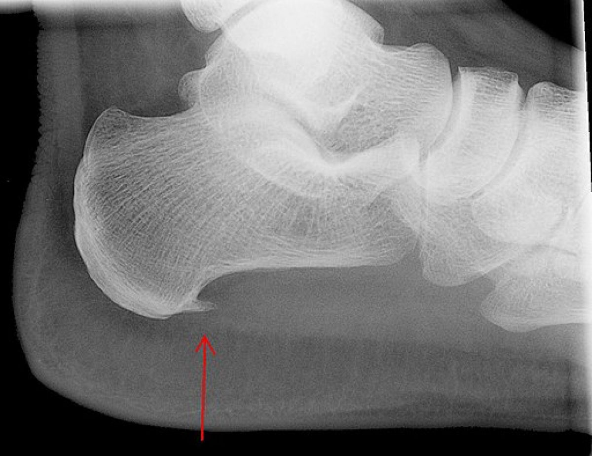 What Is a Heel Spur? | Orthopaedic Associates of Central Maryland