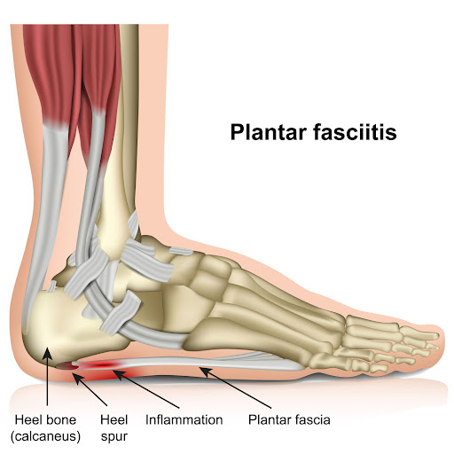What is Plantar Fasciitis? - The Physio Depot