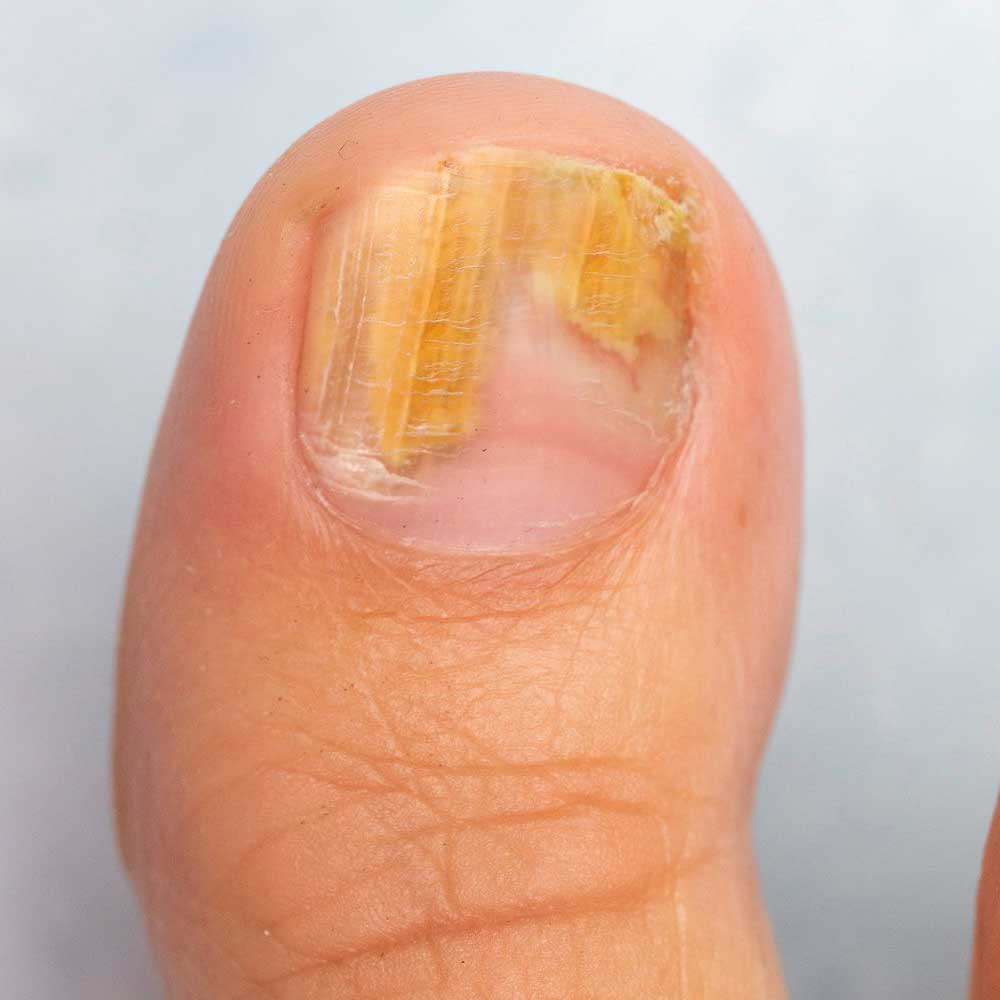 Fungal Nail Infection: causes, symptoms, diagnosis and treatment | PPT