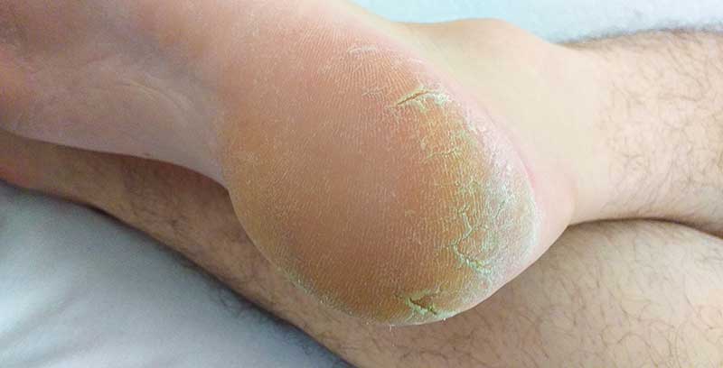 Entre's Foot Balm: Organic Antifungal Foot Cream For Dry Feet, Calluses,  Athletes Foot, Toenail Fungus, Odor, EntreFeet Foot Care, Tired Achy Itchy  Feet, Oz | lupon.gov.ph