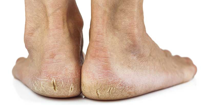 Cracked Heels, Dry Cracked Feet & Heel Fissures | Elite Podiatry