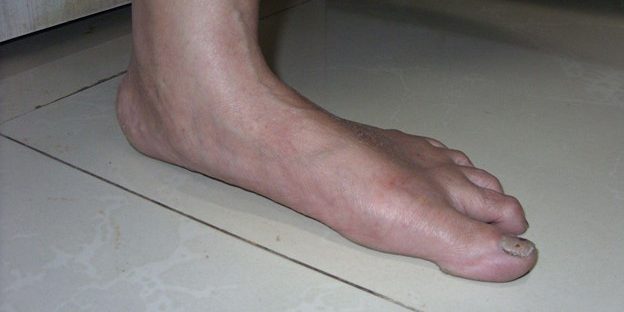 Flat Feet Causes Symptoms And Treatment Foot And Ankle