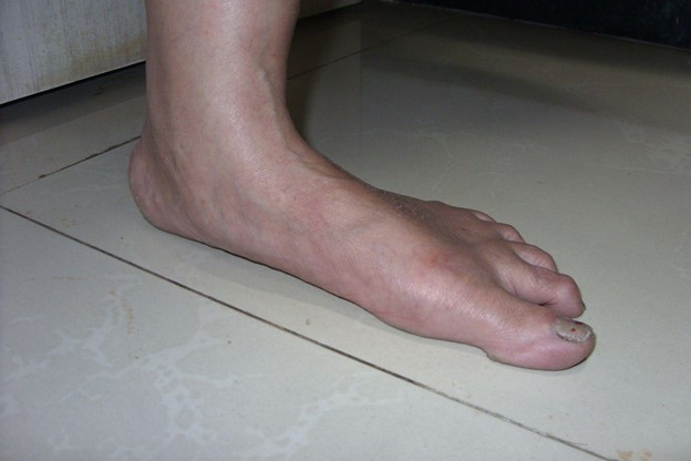 flat-feet-causes-and-treatment