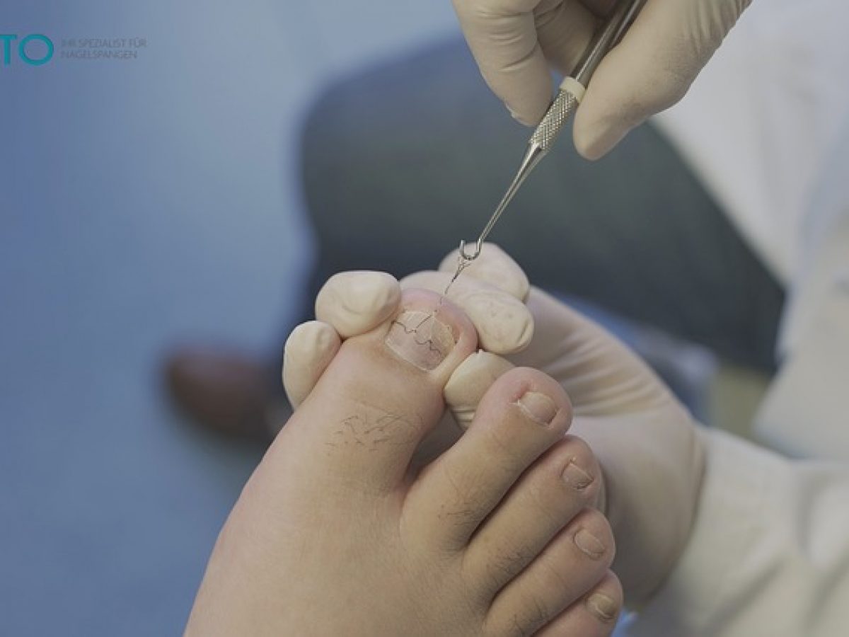 Will an Ingrown Toenail Eventually Grow Out? - Foot And Ankle