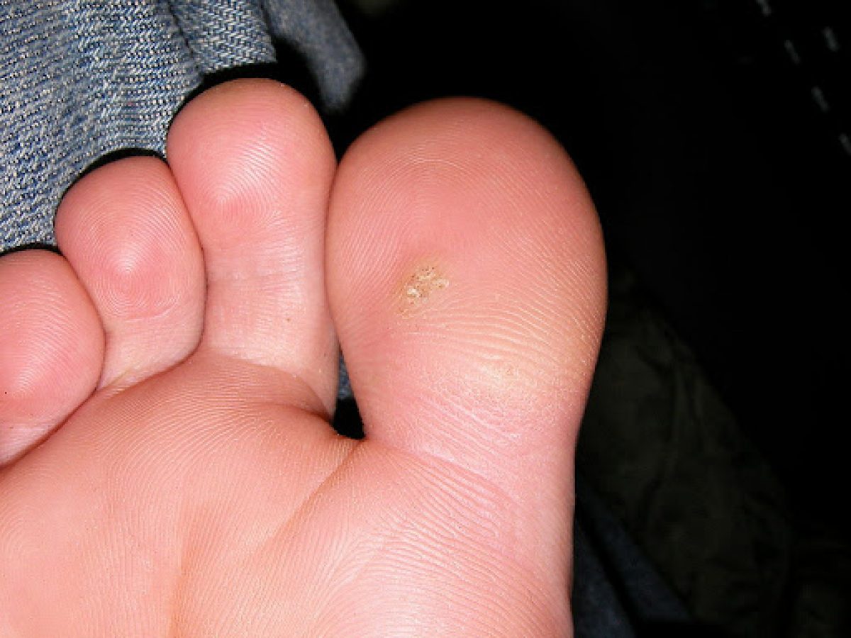 Types of Warts on Feet: Pictures Causes Treatment