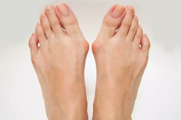 Bunion Bunion surgery