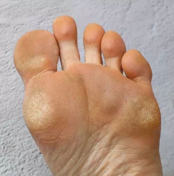 calloused-feet-treatment