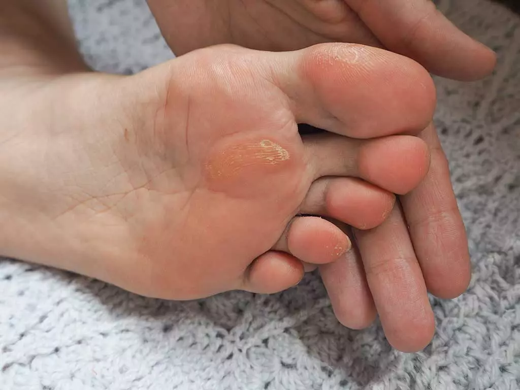 corns-and-calluses-example