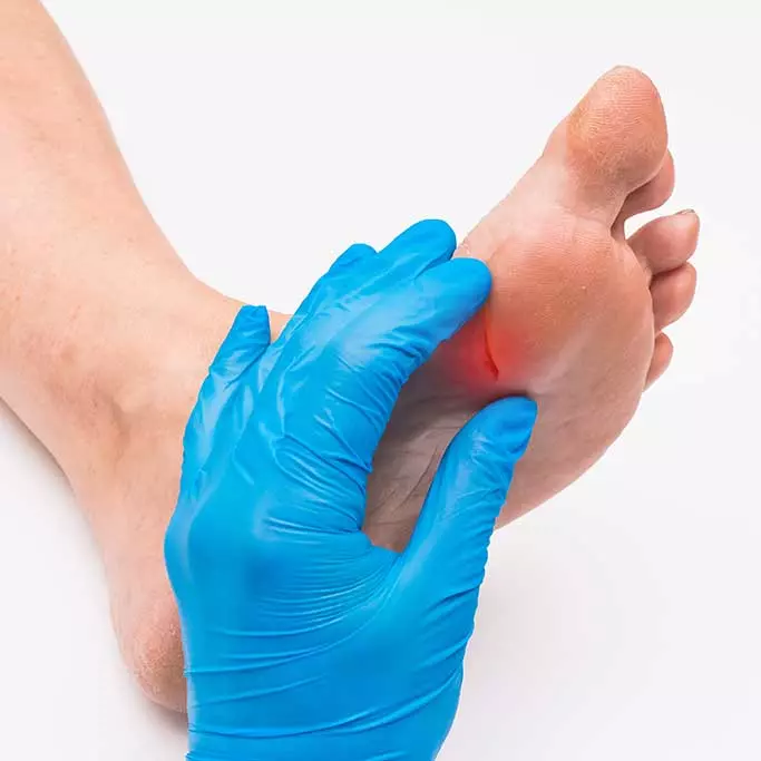 diabetes-and-poor-circulation-example