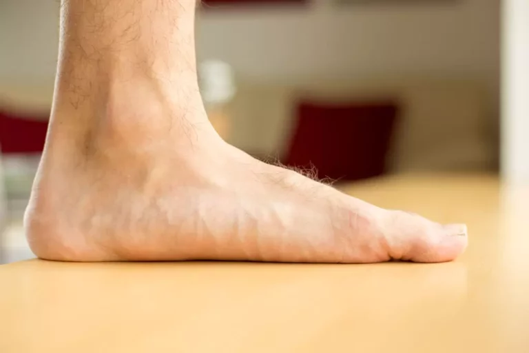 footcondition-flat-feet-adelaide-podiatrist