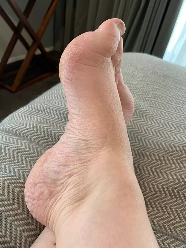footcondition-high-arched-feet-adelaide-podiatrist footcondition-high-arched-feet-adelaide-podiatrist