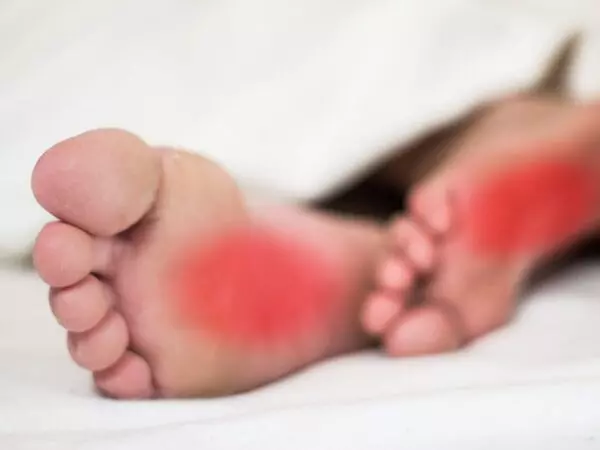 hot feet causes