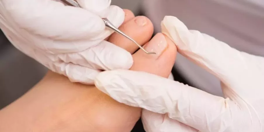 ingrown toenail remedies